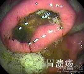 胃溃疡吃瓜行吗,吃瓜需谨慎，了解这些饮食原则